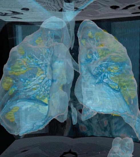 Mira el ataque del covid-19 a los pulmones en 3D